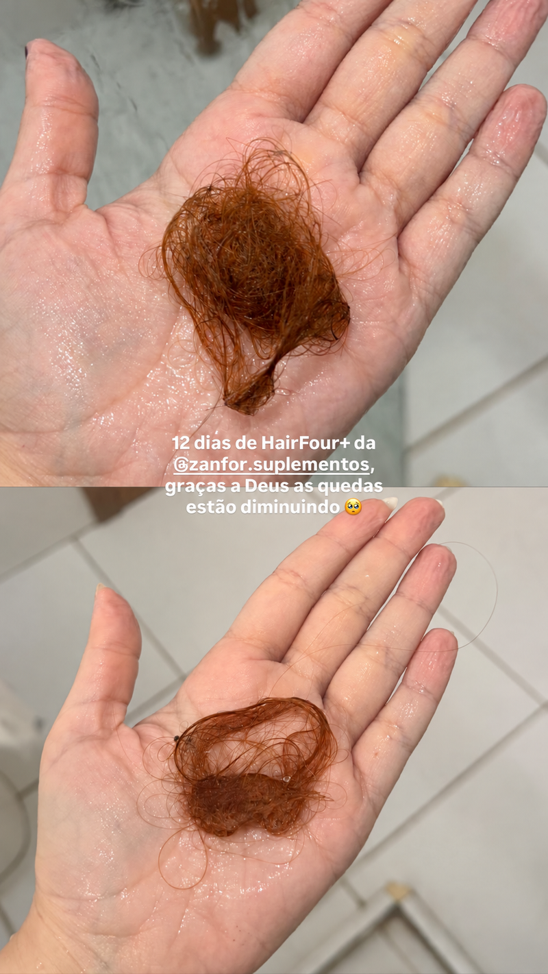 Relato HairFor+ queda